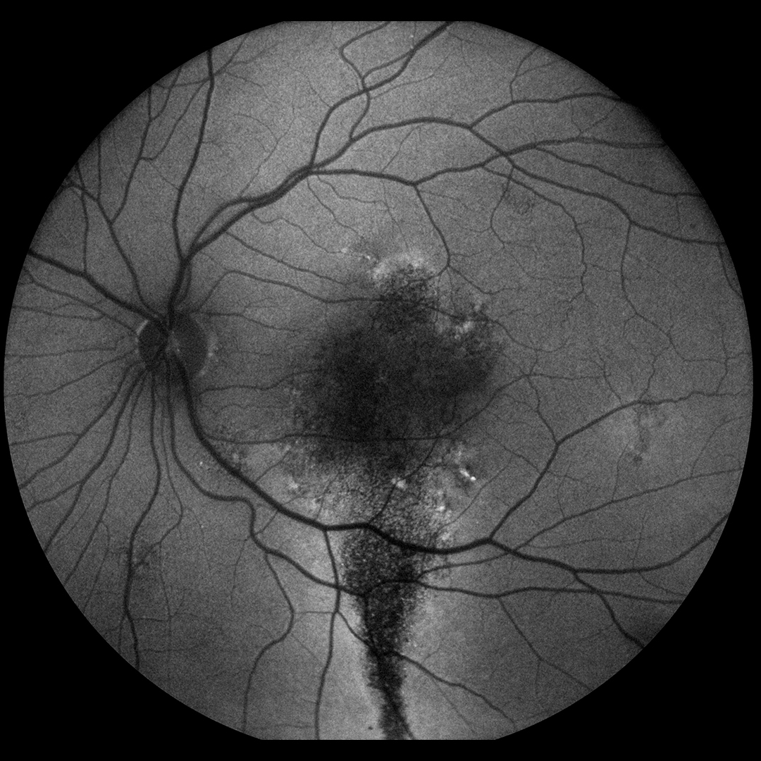 EIDON Autofluorescence retinal image sample