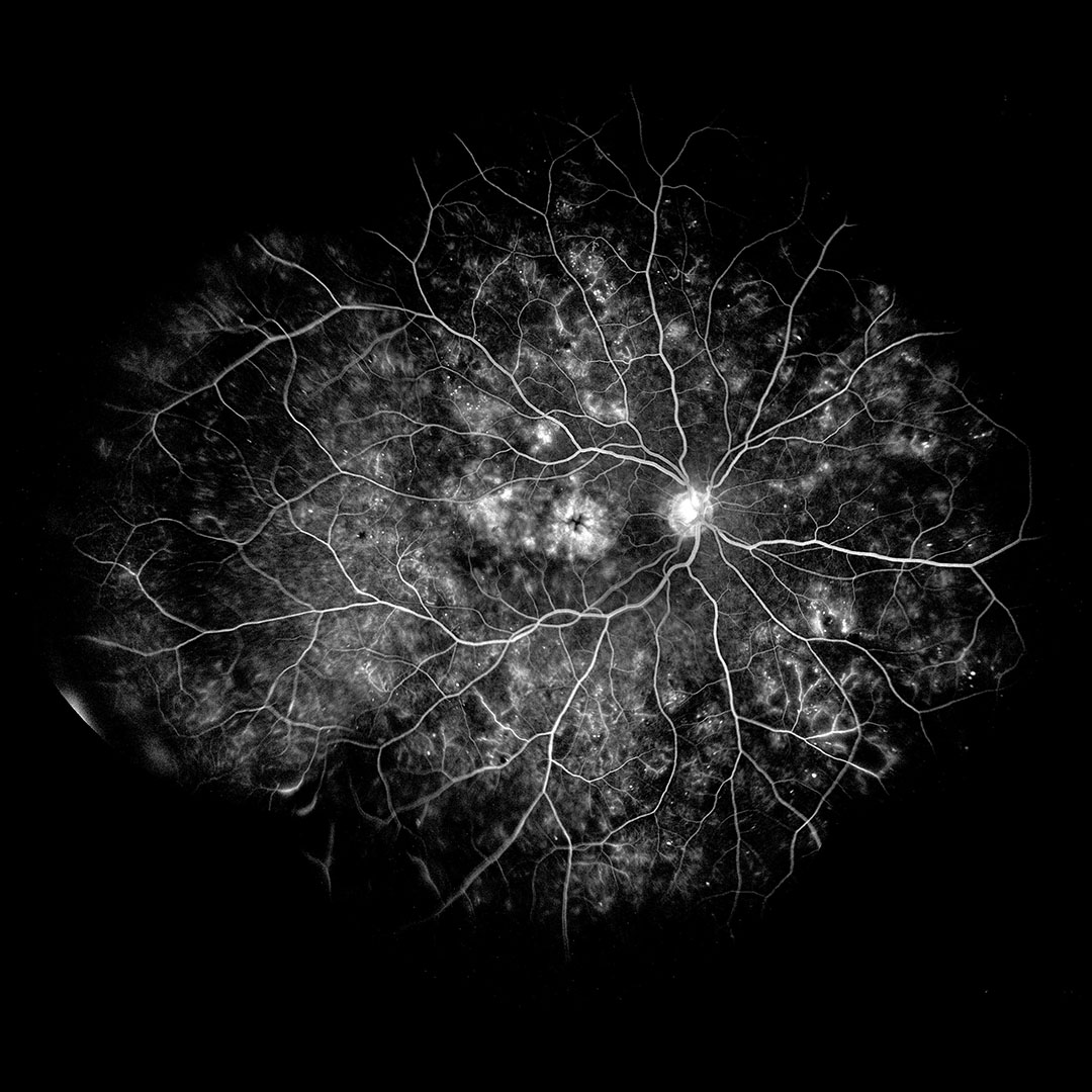 EIDON Fluorescein Angiography retinal image sample