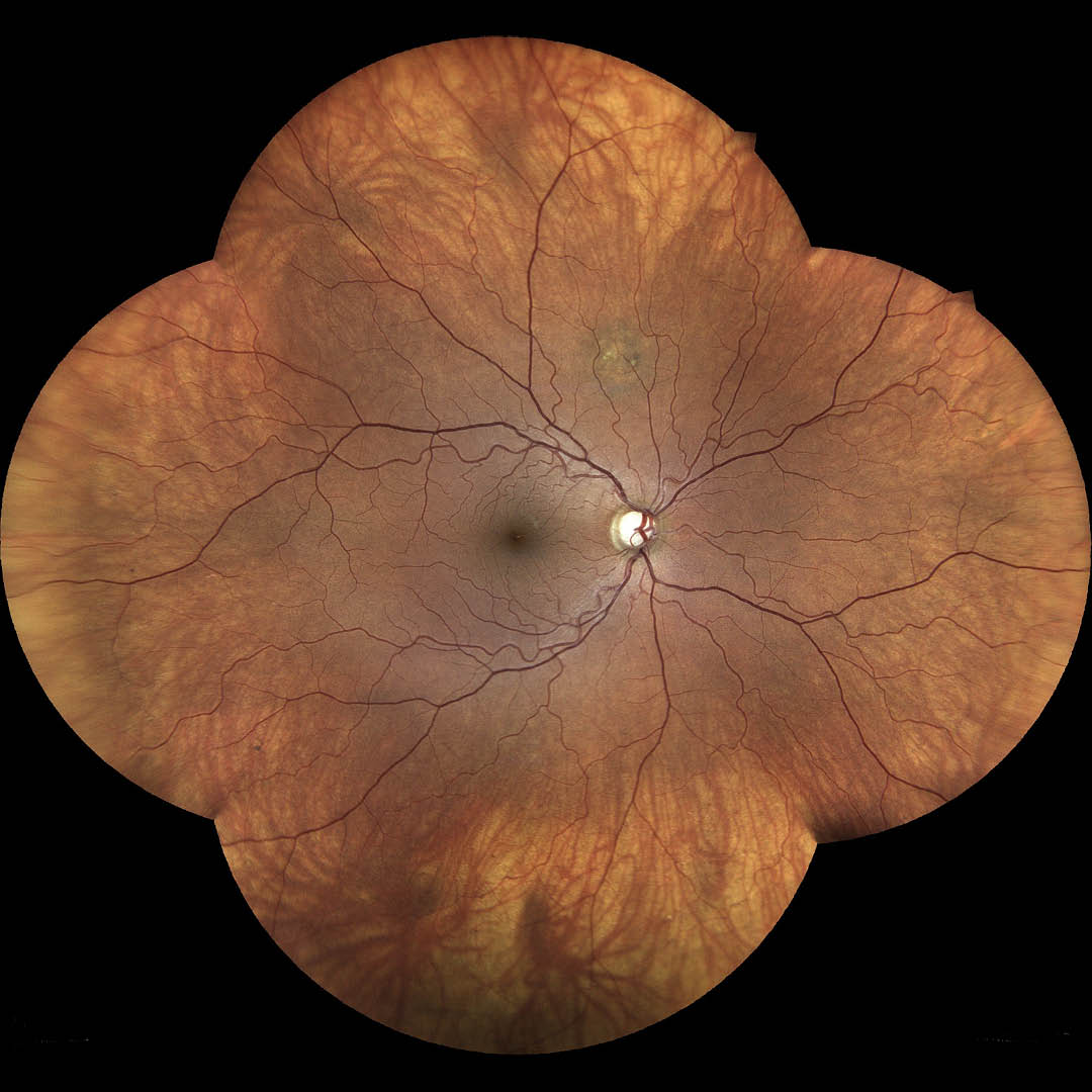 EIDON TrueColor retinal image sample